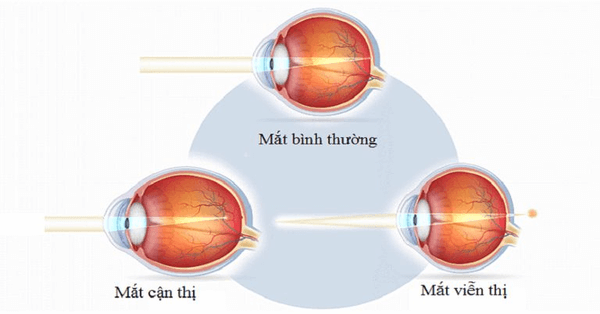 Cận thị và viễn thị là hai căn bệnh về mắt phổ biến nhất
