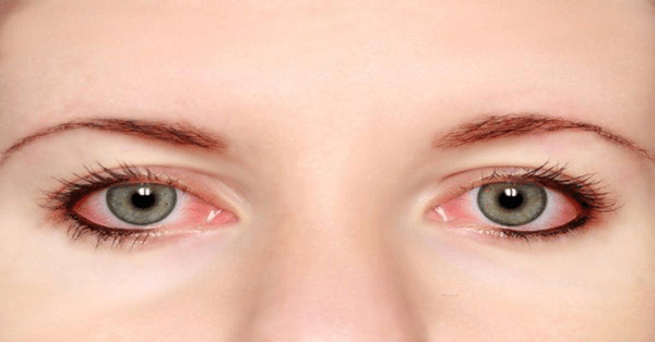 Bệnh đau mắt đỏ không quá nguy hiểm nhưng khá phổ biến