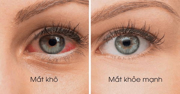 Khô mắt dẫn đến mỏi mắt và điều tiết kém