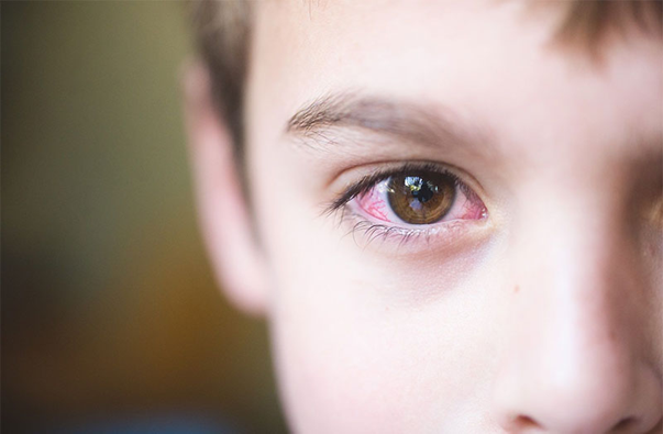 Các bệnh về mắt ở trẻ em