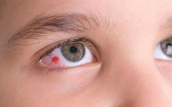 Triệu chứng đỏ có đốm đỏ - Dấu hiệu các bệnh về mắt