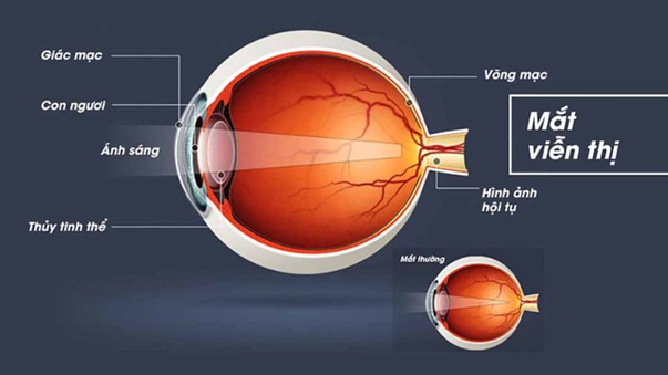 Mắt của trẻ mắc tật viễn thị