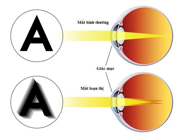 Loạn thị và cận thị là hai bệnh về mắt thường gặp hiện nay