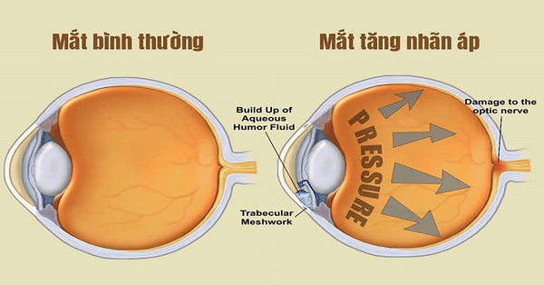 Mắt bị tăng nhãn áp nên được theo dõi thường xuyên