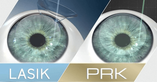 Hai phương pháp LASIK và PRK là phổ biến nhất