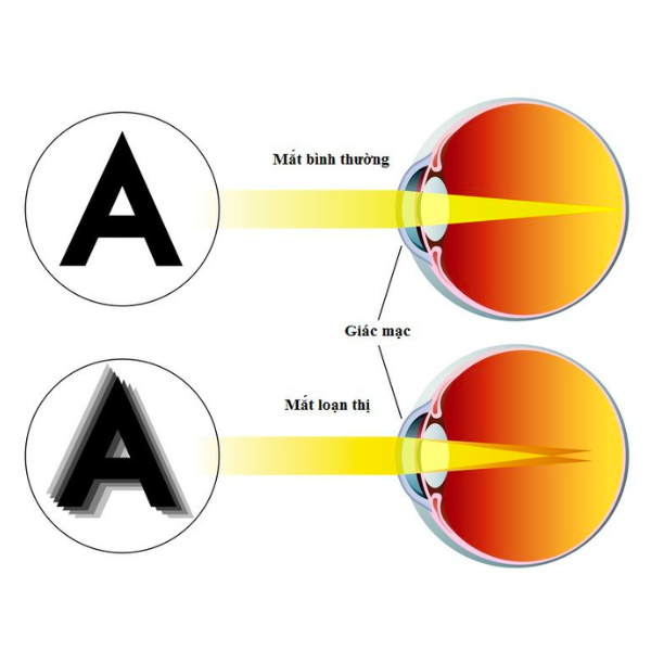 Loạn thị có khả năng tăng độ giống cận thị