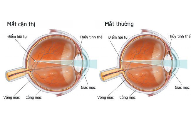 Cận thị (Myopia, Nearsightedness) là một loại tật khúc xạ thường gặp nhất ở mắt