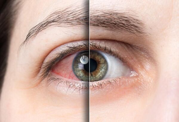 Mắt bị thiếu oxy trong thời gian dài sẽ rất dễ bị đỏ và đau mỏi