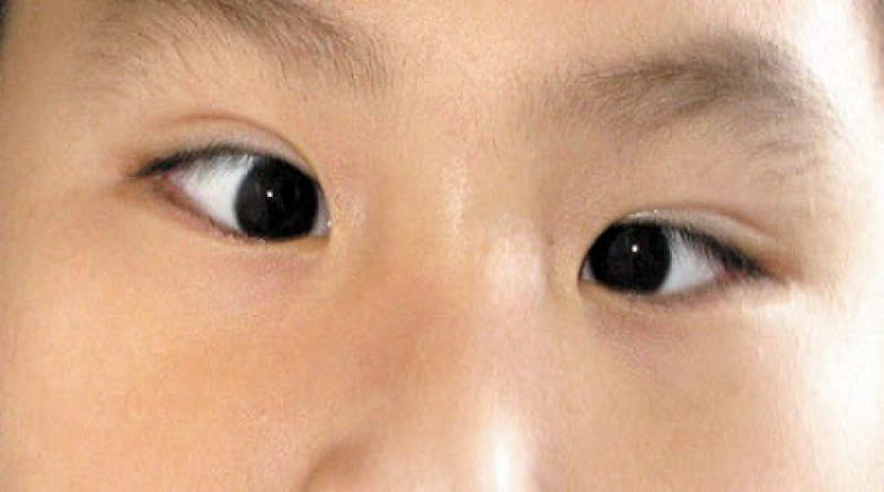 Lác mắt bẩm sinh có chữa được không?