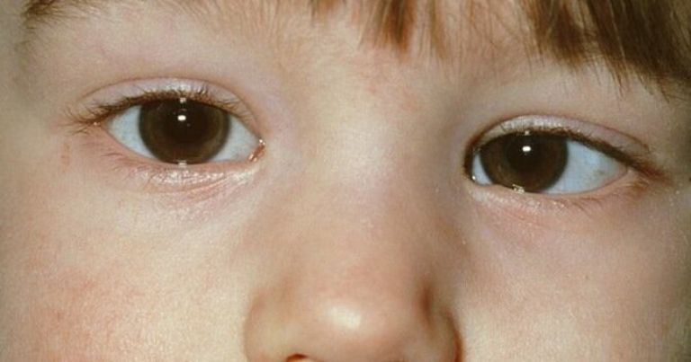 Trẻ em mổ mắt lác có đau và nguy hiểm không?
