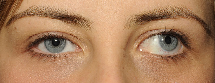 Tình trạng mắt lác kéo dài mà không được điều trị có thể gây ra tình trạng nhược thị